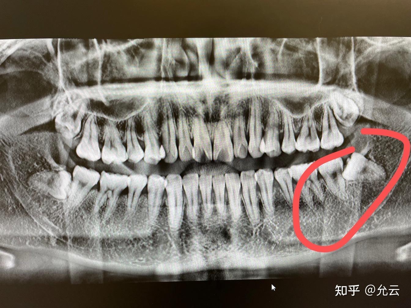 26岁拔了人生第一颗阻生齿分享一下些许惨痛经历