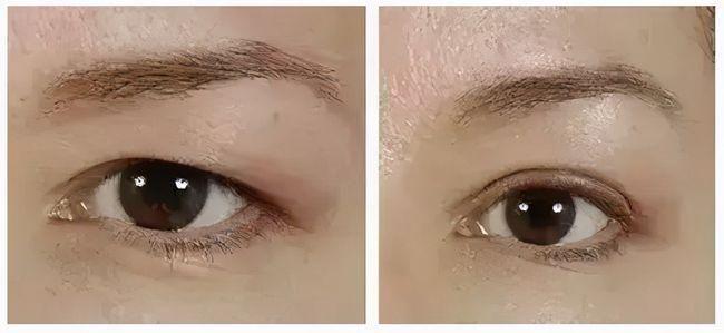 eye美颜究苑丨上了年纪眼皮松弛下垂影响美观怎么办
