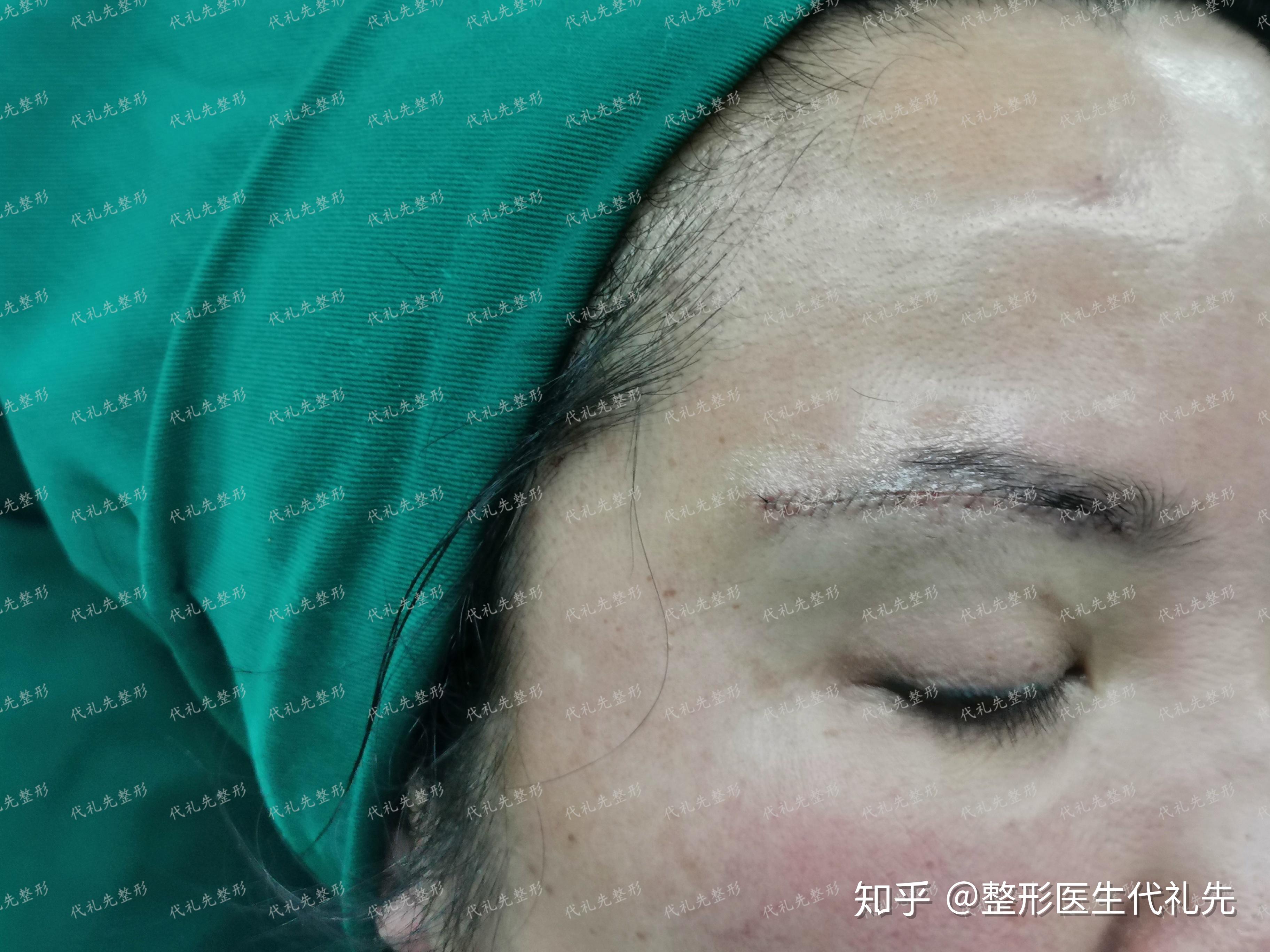 北京切眉手术 - 知乎