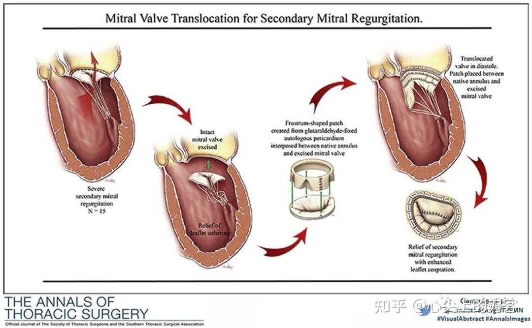 入路:房间沟入路.手术方法作者为麻省总医院心脏外科的james s.