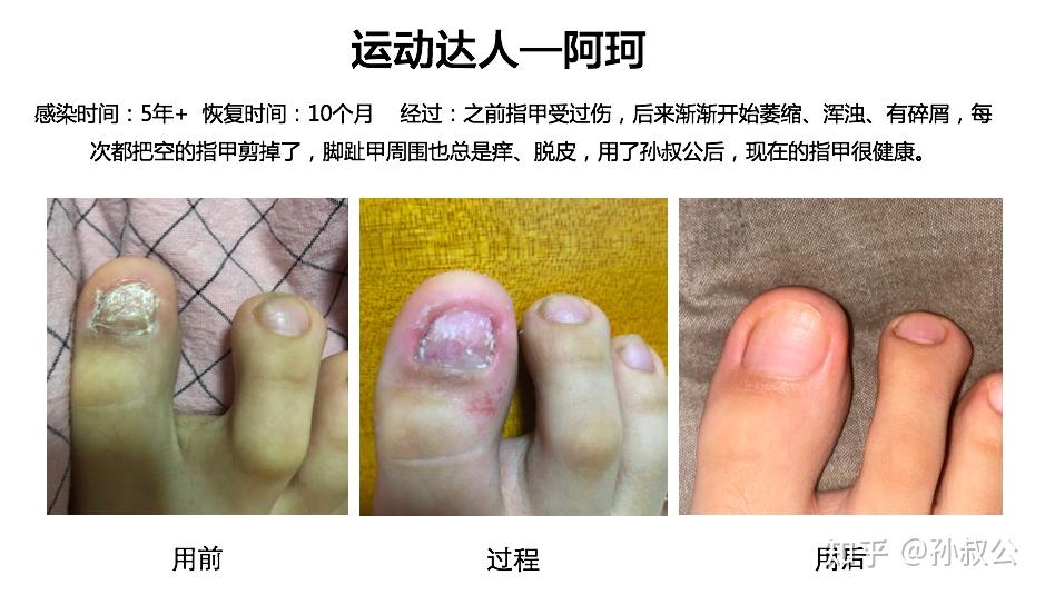 灰指甲甲萎缩型40史前爆料你不得不看的真实案例合集详图版