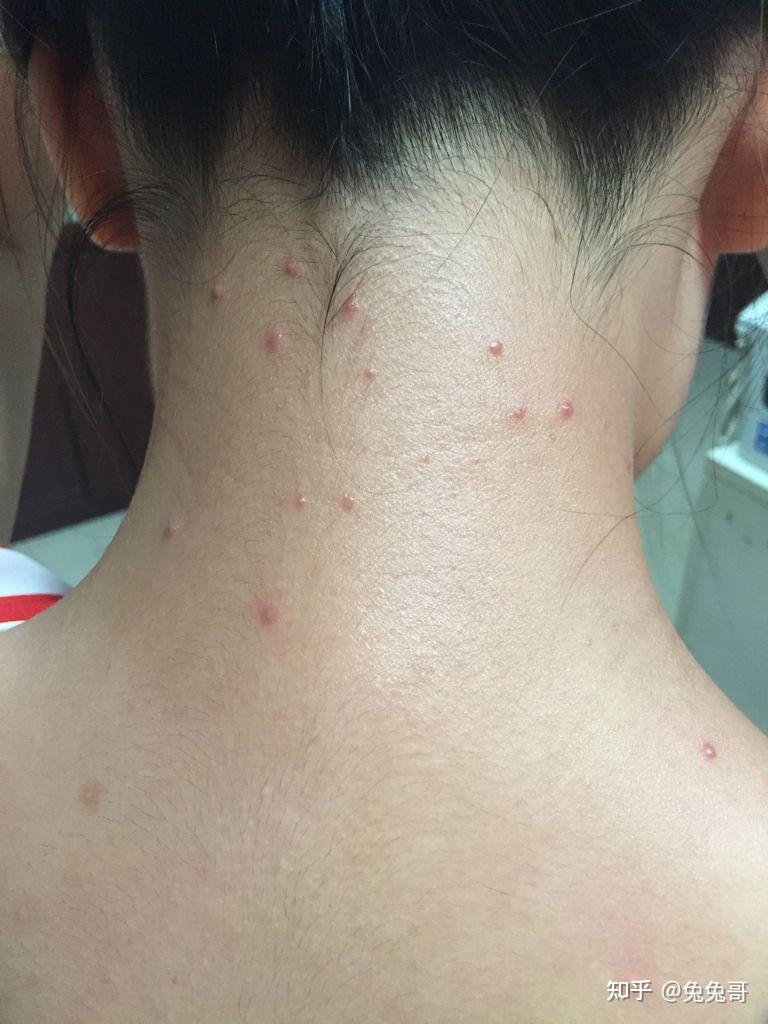 毛囊炎有哪些临床症状 - 知乎