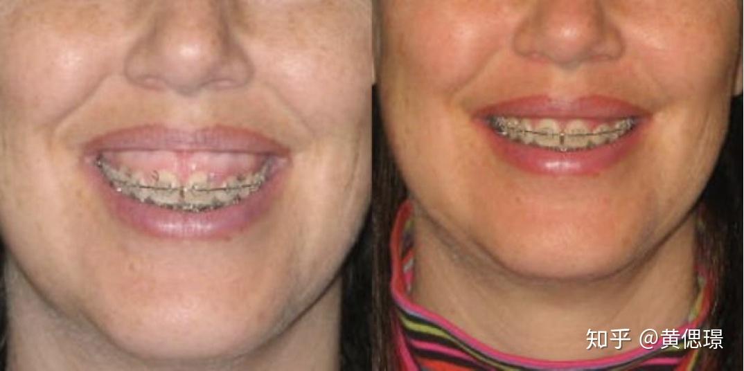 想改善露龈笑得知道这些 - 知乎