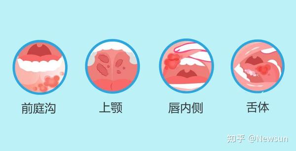 长在这个位置的口腔溃疡,癌变风险高? - 知乎