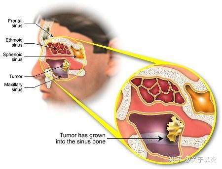 鼻竇炎會發展成鼻竇癌嗎這些因素才是病因