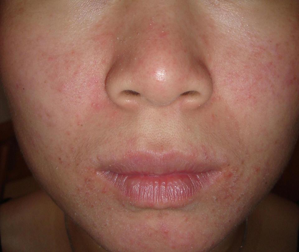 有皮屑):图一(症状比较轻,皮肤有轻微黄红色斑片,有皮屑):脂溢性皮炎