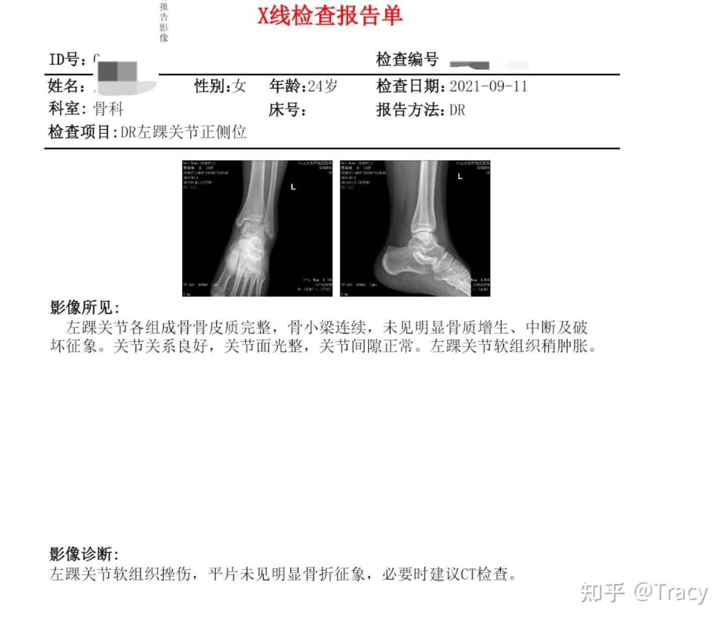 跟骨骨折x线报告模板图片