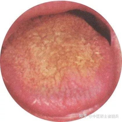 史上最全高清舌诊图谱，堪比教科书（收藏篇） - 知乎