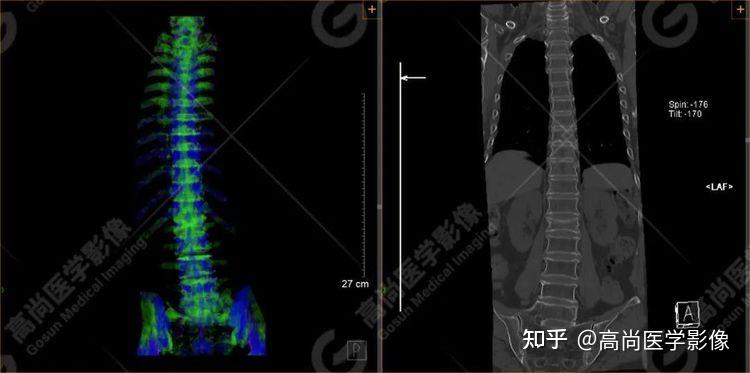 影像检查选ct扫描还是磁共振?