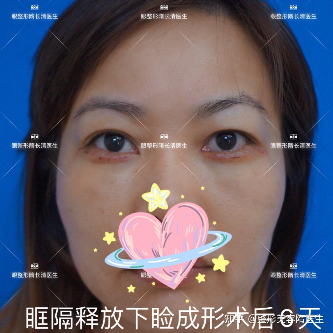 北京全切双眼皮 去脂 眶隔脂肪释放：案例详细分析 - 知乎