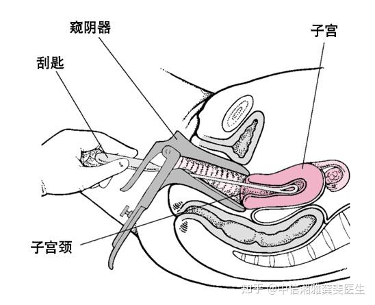 这种刮宫你听说过吗?