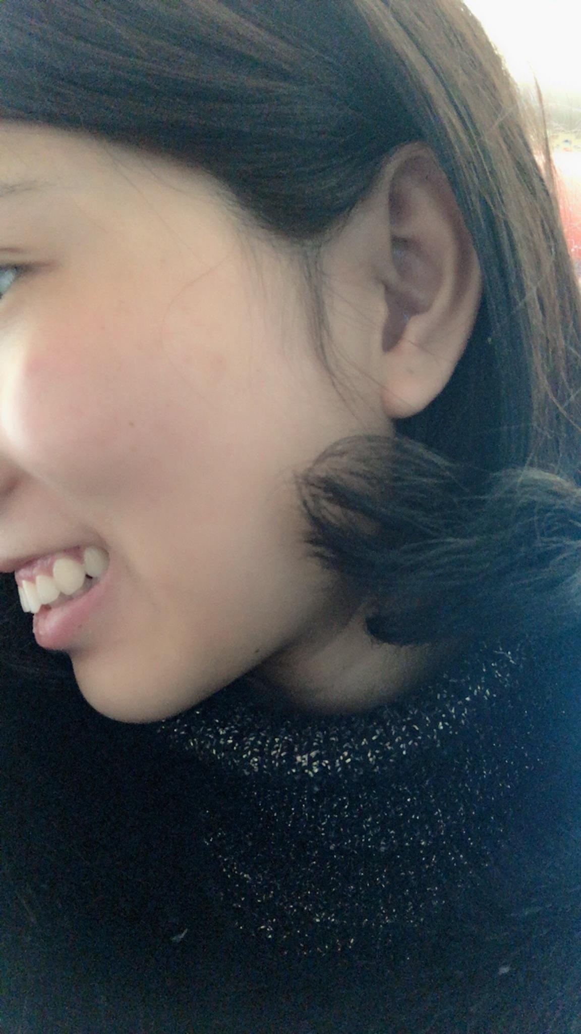 龅牙凸嘴怎么改善侧脸