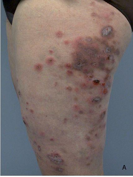     滑动查看下一张图片  >>是的,如果反复受冷,寒冷性脂膜炎也可能