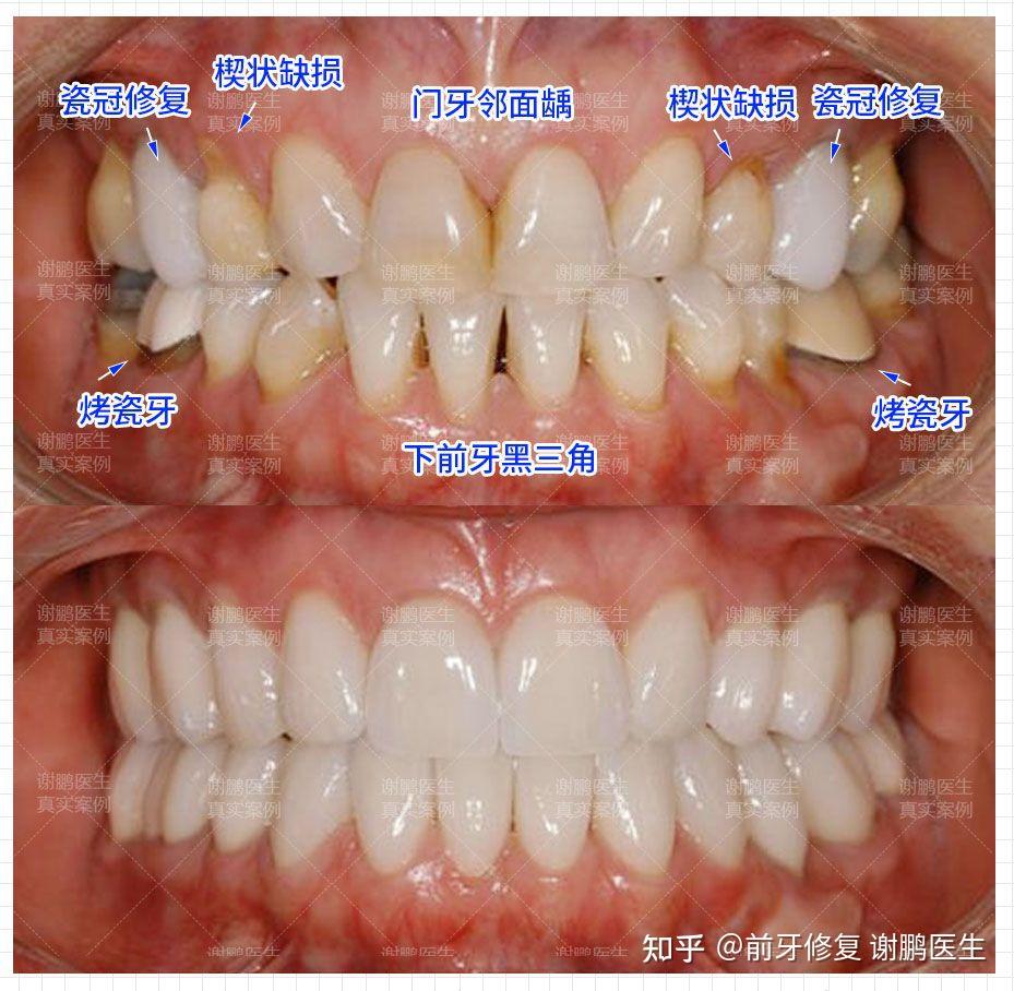 牙齦也有萎縮,之前在外院做過2顆瓷冠修復和2顆烤瓷牙,但是邊緣不密合