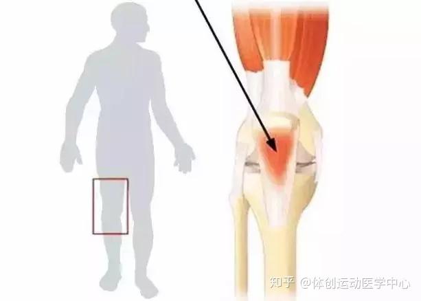 膝前痛 跑跳痛 可能是髌腱炎惹的祸 知乎