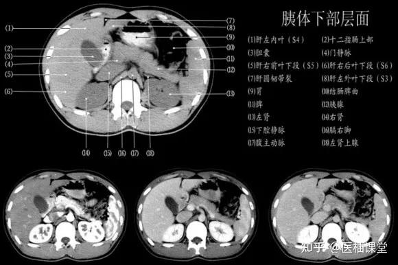 脾动脉CT解剖图图片
