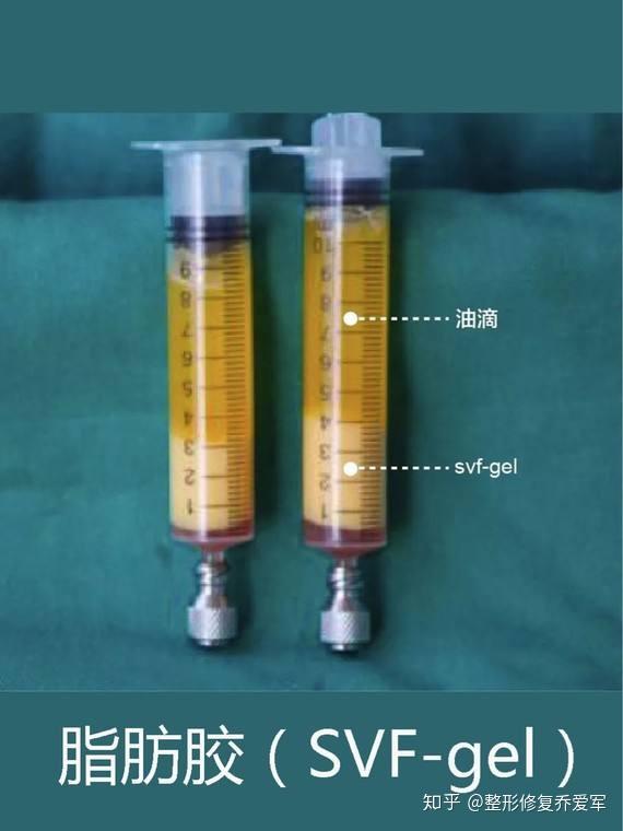 关于脂肪干细胞胶（svf）与普通脂肪移植的对比 - 知乎