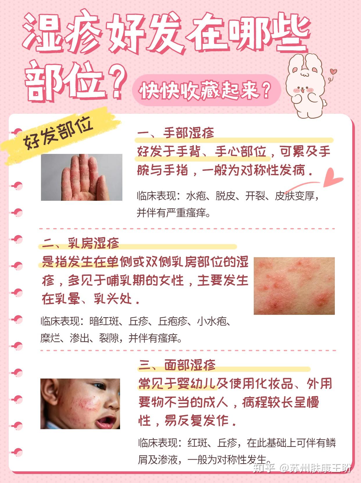 痒痒痒!湿疹好发部位 快来看看你是哪一种吧! - 知乎