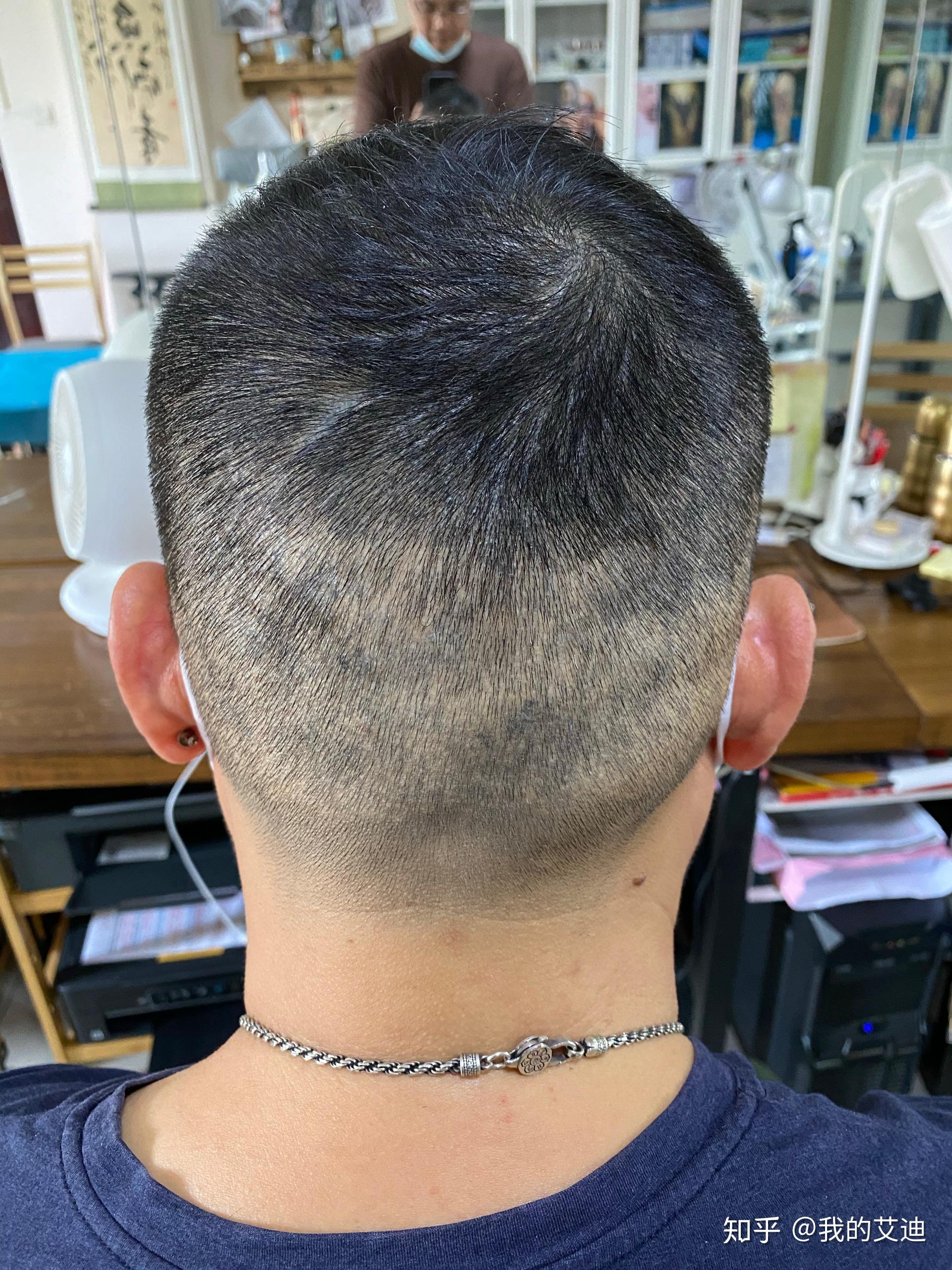 植发微针留下的取毛囊小疤痕纹发修饰效果很好 - 知乎