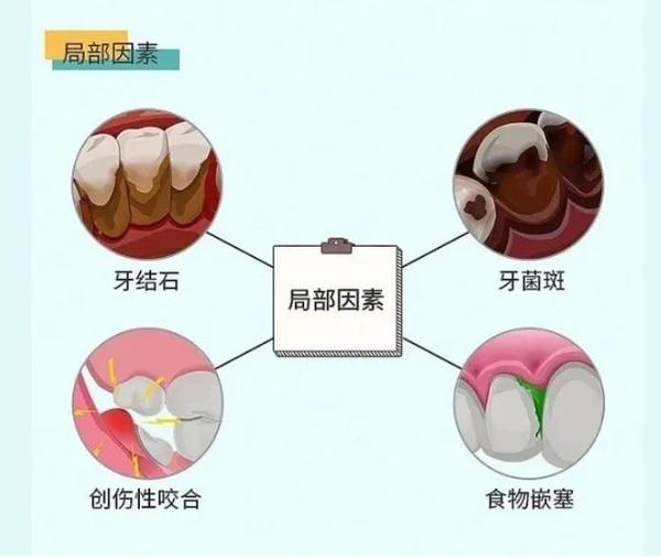 怀疑自己得了牙周炎?赶紧自查一下 - 知乎