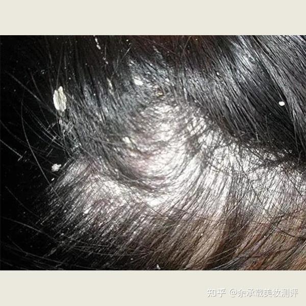 头皮痒长头皮屑用什么洗发水?去屑止痒控油洗发露排行 - 知乎