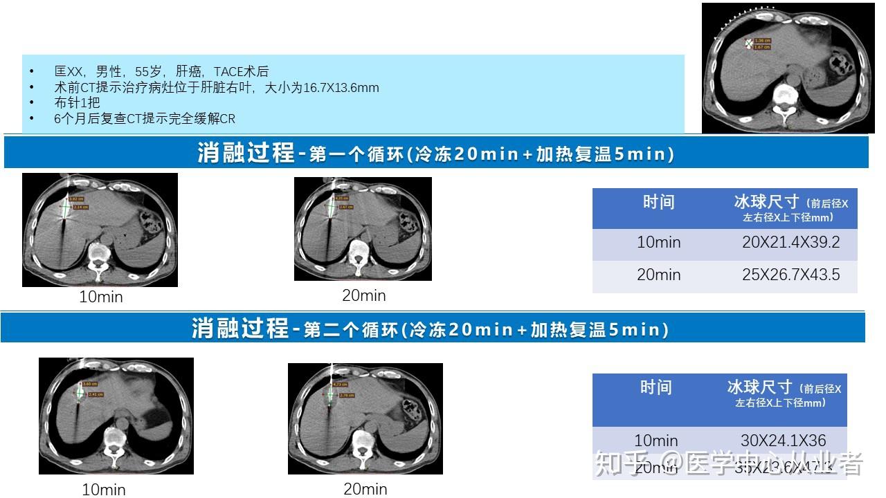 康博刀医学中心手术范例5月16日更新