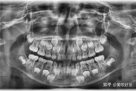 婴儿牙齿ct图图片