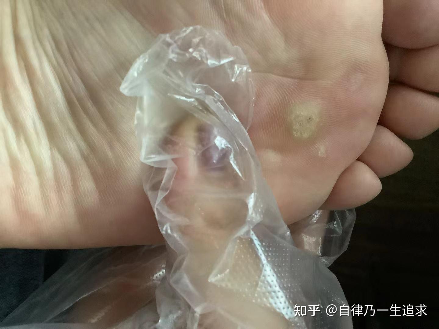 我的完整蹠疣治療過程記錄