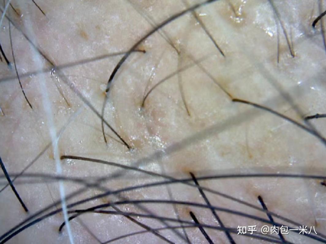 头皮毛囊 zhuanlan.zhihu.com