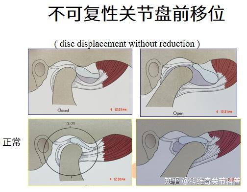 科普答疑不可复关节盘移位到底是什么