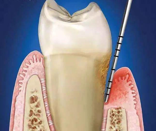 牙周炎自愈最佳方法图片