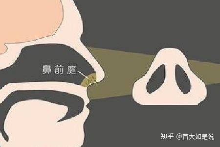 鼻前庭炎的症状图片集锦 鼻前庭囊肿图片 鼻前庭炎图片