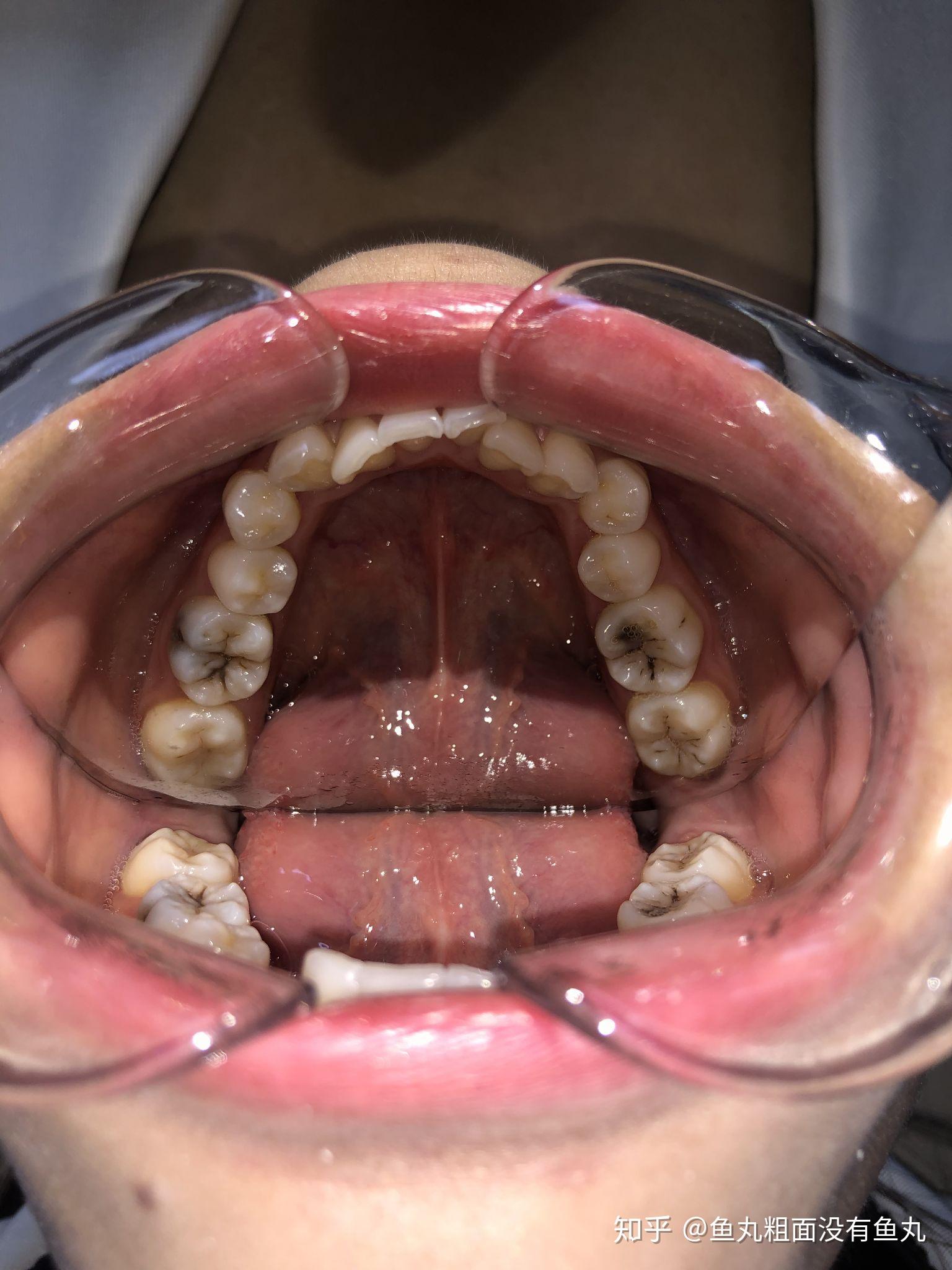 其实牙齿还是挺白的哈哈哈下面是我戴牙套后的照片,我是9.