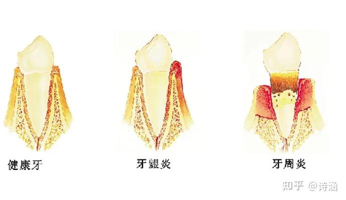 牙周炎如何护理口腔?20条危害禁忌必须搞懂! - 知乎