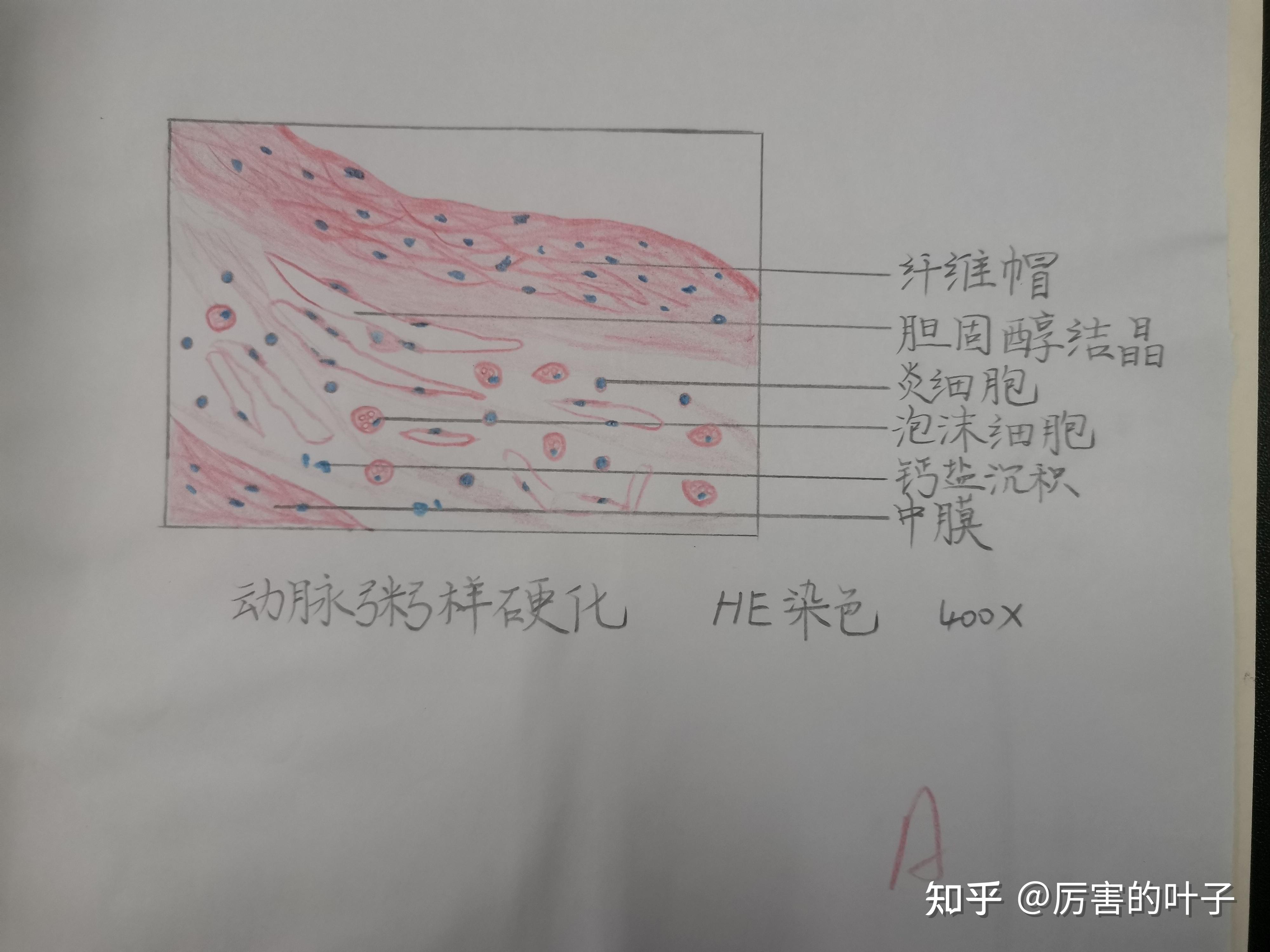 病理血栓红蓝铅笔绘图图片