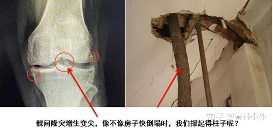 老年人的膝关节x线片报告我们经常见到:髁间隆突变尖,内侧关节间隙