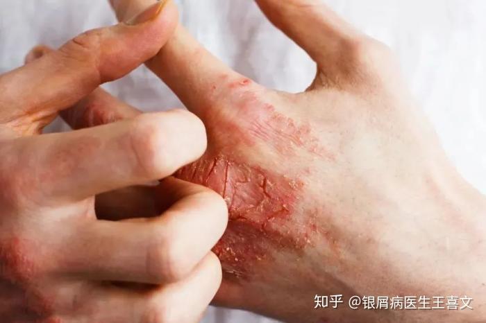 银屑病患者适合用什么身体乳(银屑病患者适合用什么身体乳护肤品)