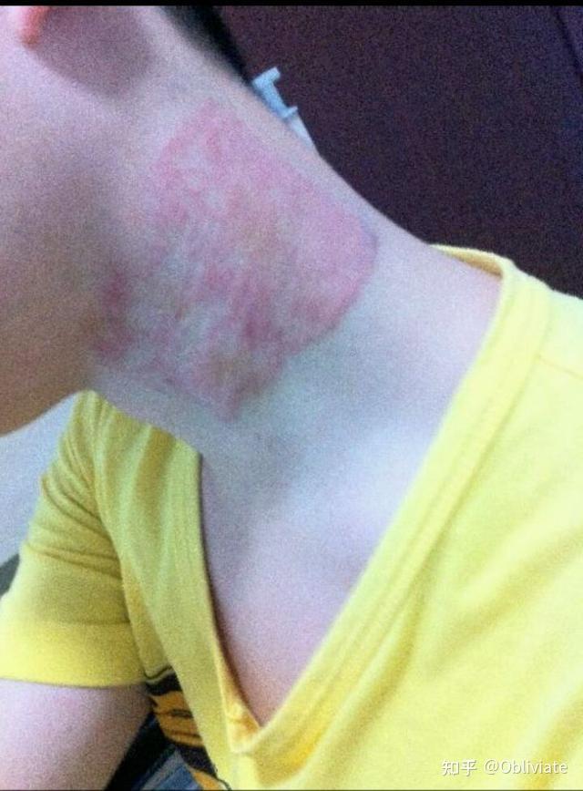 为啥一到春秋换季,皮肤就容易起皮爆皮,红敏刺痛? - 知乎