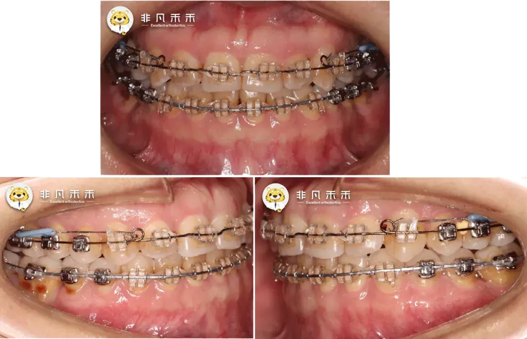 正畸病例牙不齊近中移動78病例一例