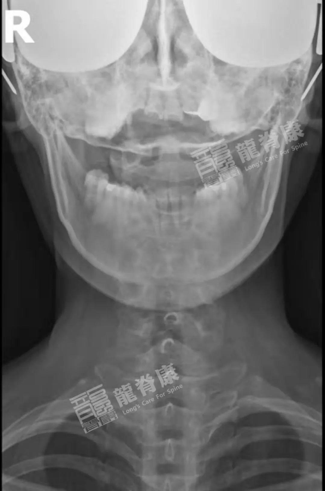 脊椎X光片分享：第4、5颈椎融椎畸形