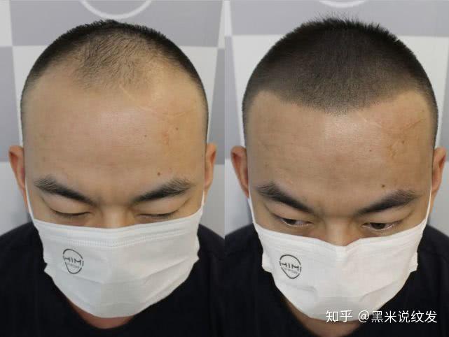 3D纹发,织发,接发,增发,植发......脱发的你都捋清楚了吗? - 知乎