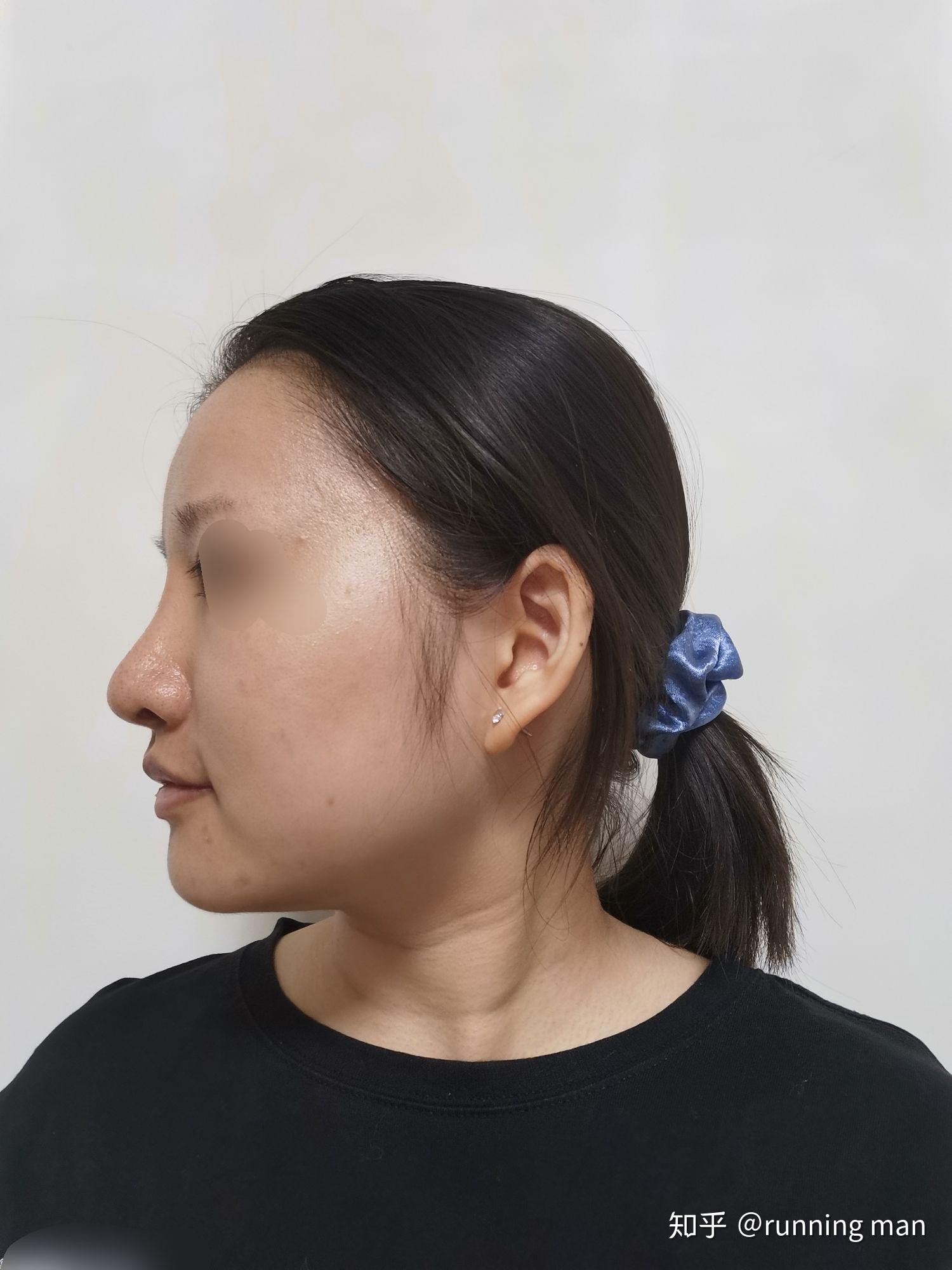 膨体隆鼻后山根高假怎么办? - 知乎