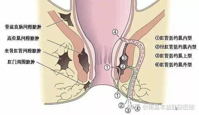 高位肛瘘手术图解图片