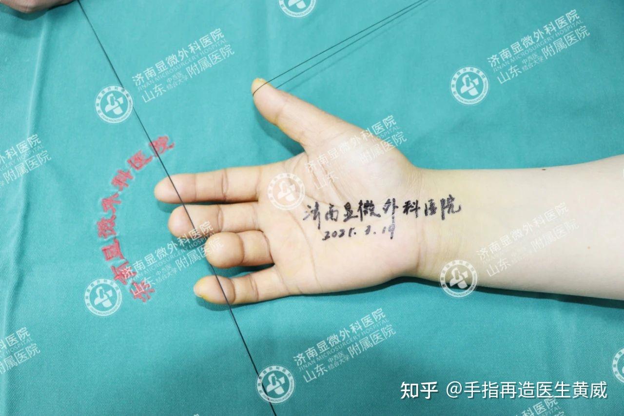 手指缺损怎么办手指再造专家告诉你答案