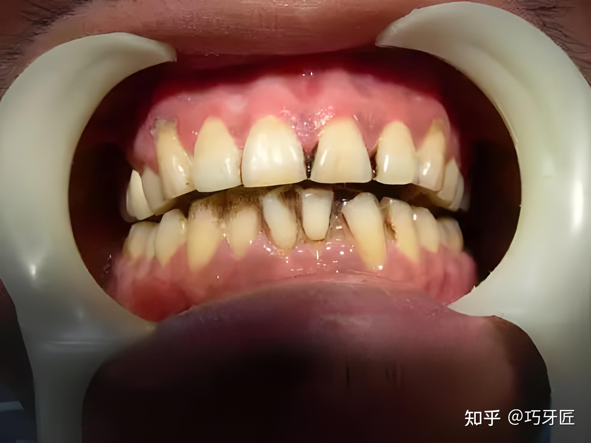 牙酸蚀症 - 口腔医学 - 天山医学院