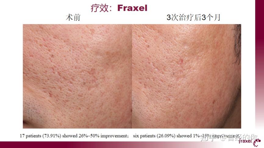 飞梭 Fraxel Dual 临床效果分享 与皮秒比如何? - 知乎