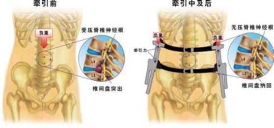 颈 腰椎间盘突出治疗手段 知乎