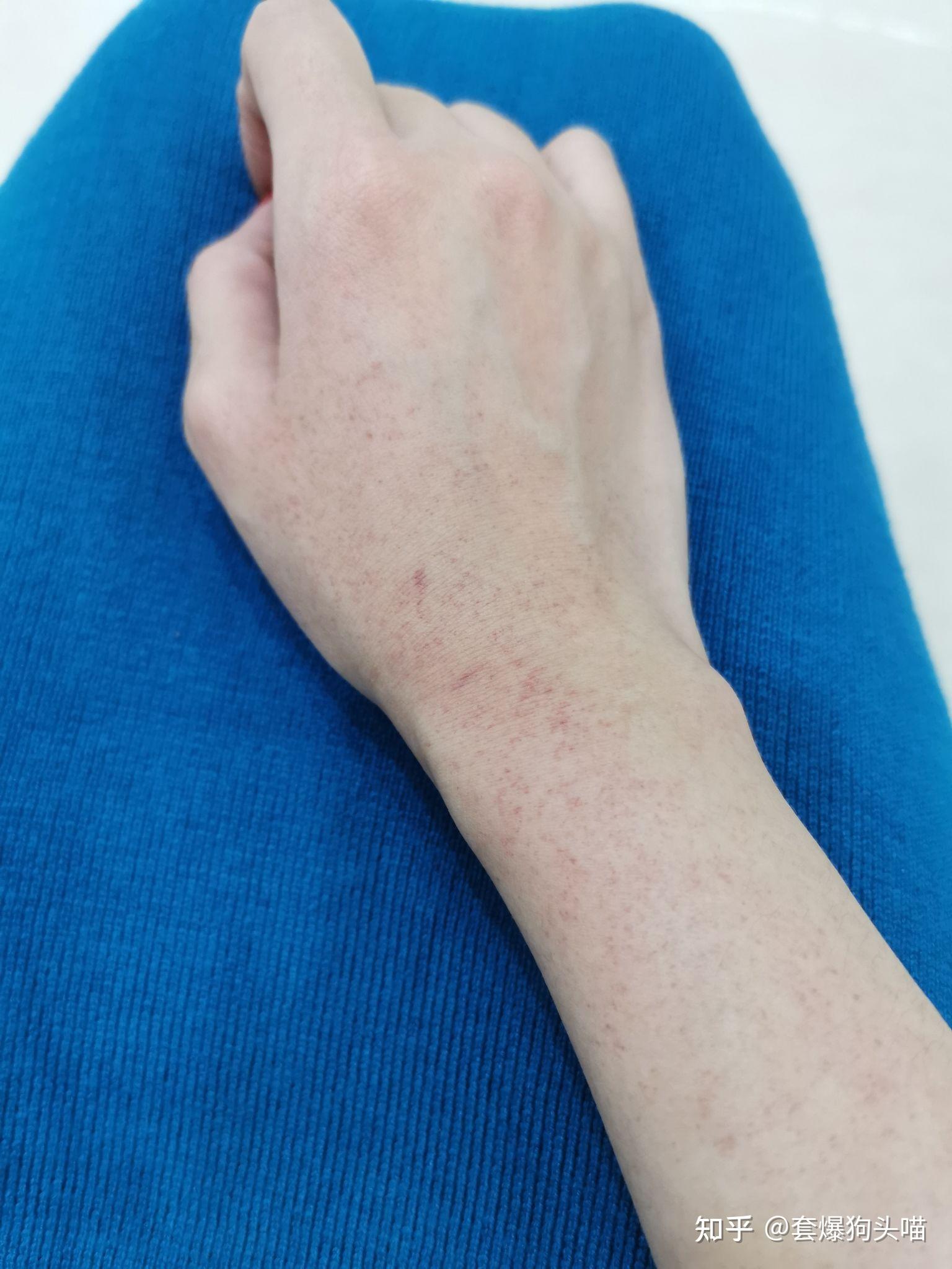 手压麻痹后出现成片血斑血点是什么症状可以消退吗
