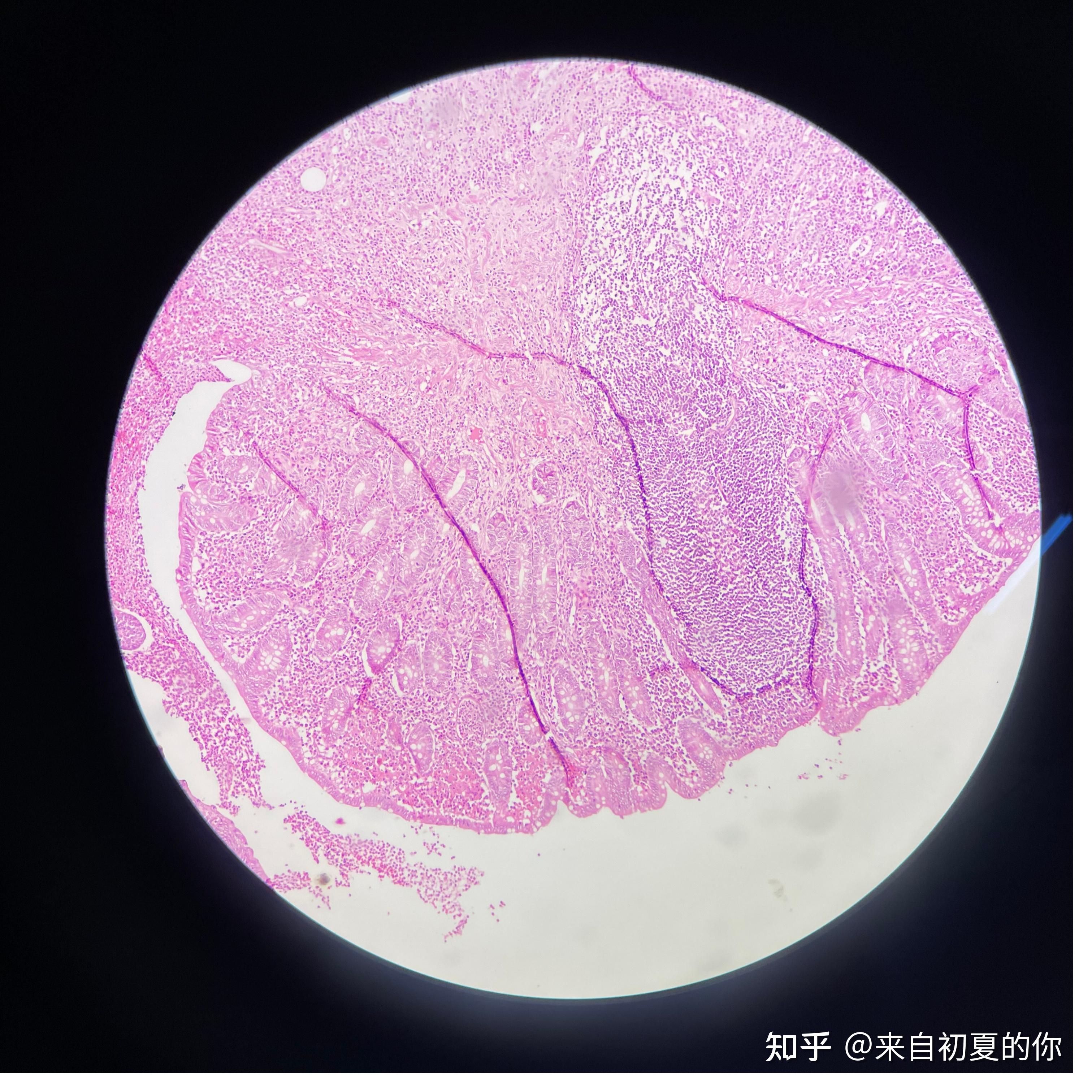 急性阑尾炎病理生理图图片