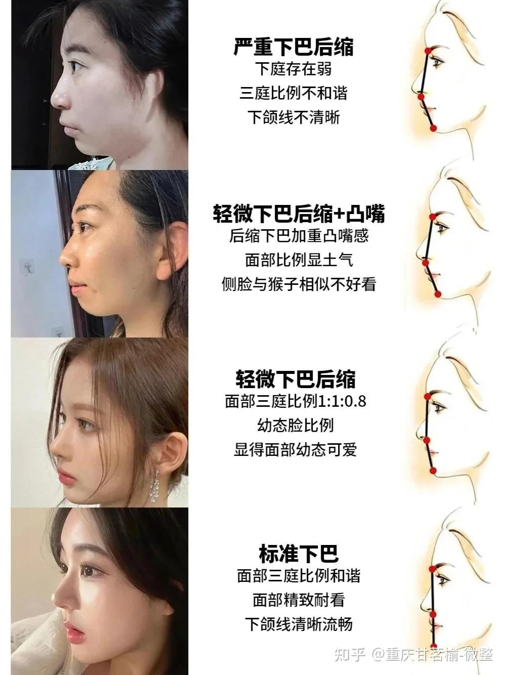 关于下巴后缩不同程度的改善思路